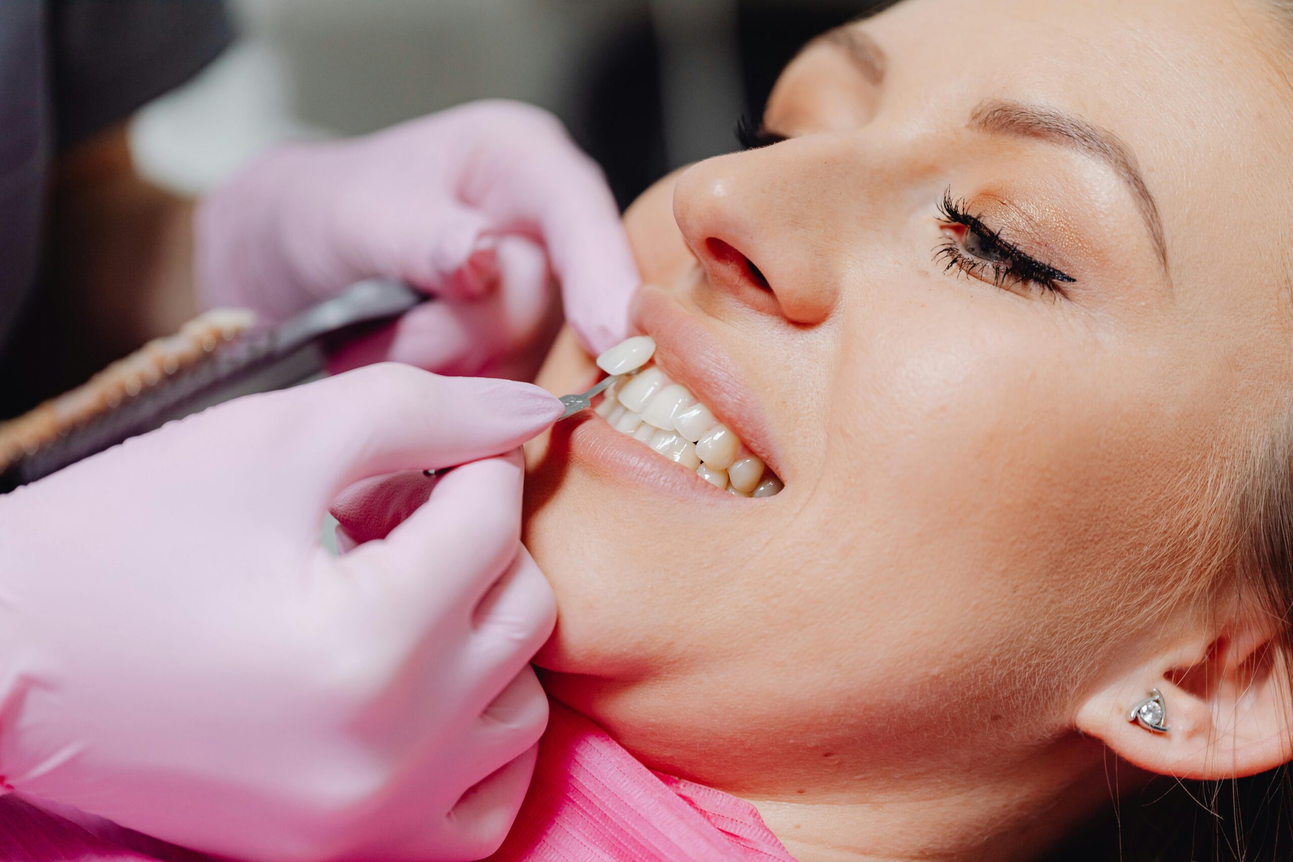procelain veneers